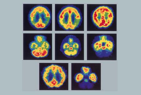 ภาพ PET scan แสดงการไหลเวียนของเลือดสู่สมอง